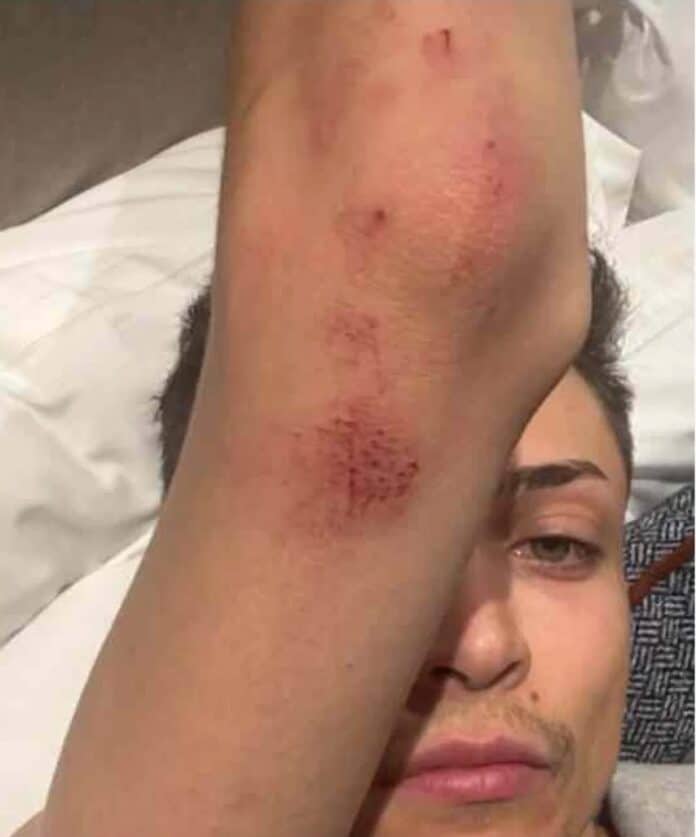 Venus Sherwood shared this image of injuries on he said he sustained from Puerto Vallarta Police - only to later retract that statement and admit the injuries were from an altercation before police became involved. Photo via Venus Sherwood instagram.